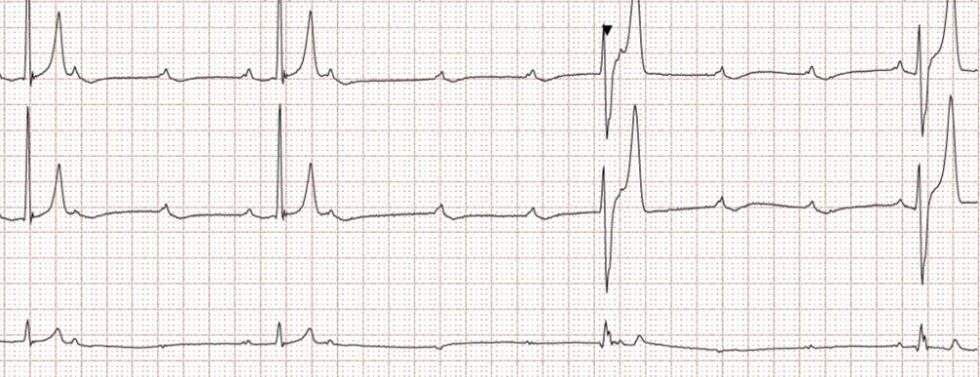 Holter recording showing sinus beats with multiple unconducted P waves and ventricular escape beats, consistent with high grade 2nd degree AVB.