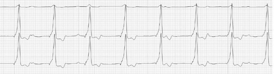 Post-operative ECG showing pacemaker rhythm. Beats appear as regular ventricular beats due to the positioning within the right ventricle. Occasional sinus P waves can be seen.